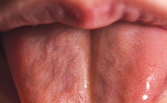 Illustration of a tongue with bumps on the back, representing the common problem of bumps on the tongue and the focus of the article.